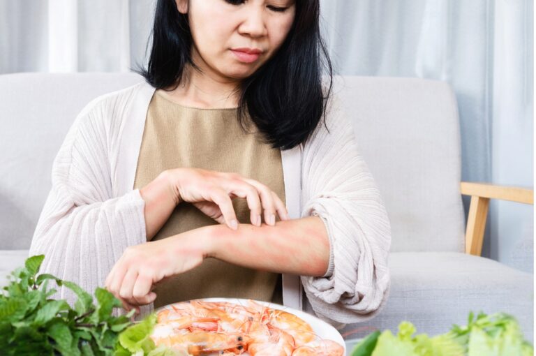 A woman has hives and is scratching at her skin due to an allergic reaction to shrimp